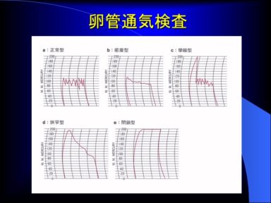 卵管通気検査