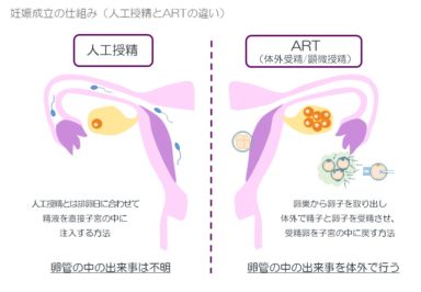 妊娠成立の仕組み（人工受精とARTの違い）